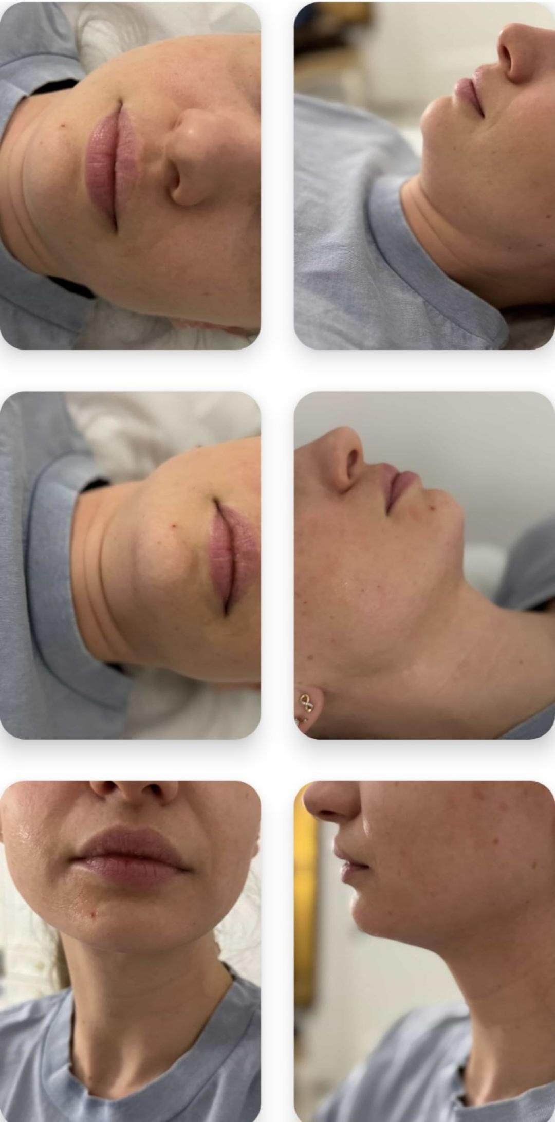 Happy in your body #beograd Tretman lica Hifu tretman - lice