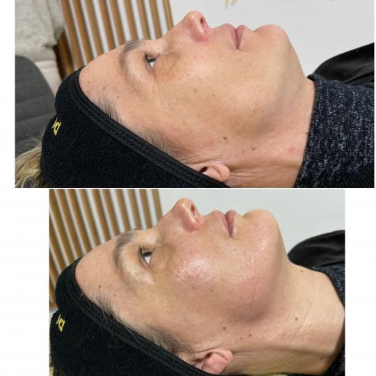 Lancier Beauty Expert #beograd Tretman lica Radiotalasni lifting - celo lice
