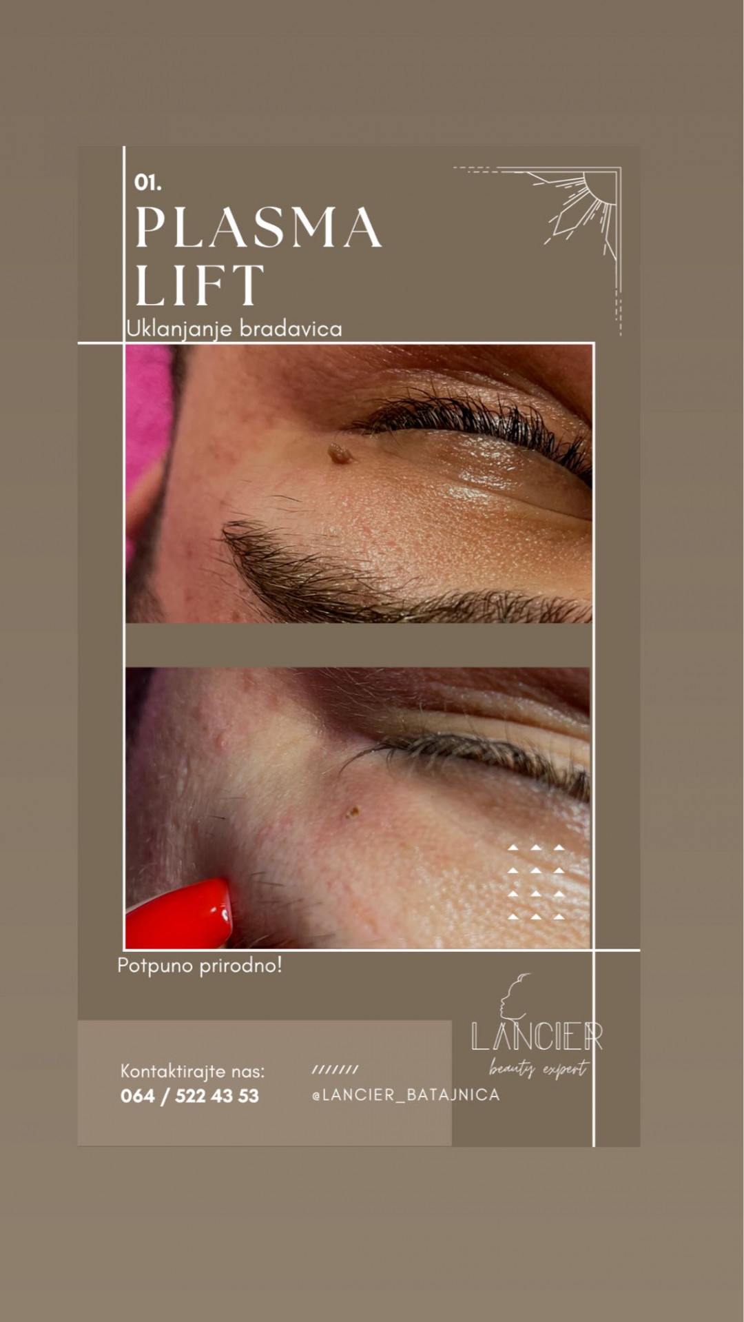 Lancier Beauty Expert #beograd Radiotalasni i ultrazvučni tretmani Uklanjanje virusnih bradavica