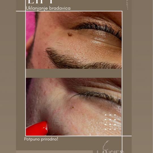 Lancier Beauty Expert #beograd Radiotalasni i ultrazvučni tretmani Uklanjanje virusnih bradavica