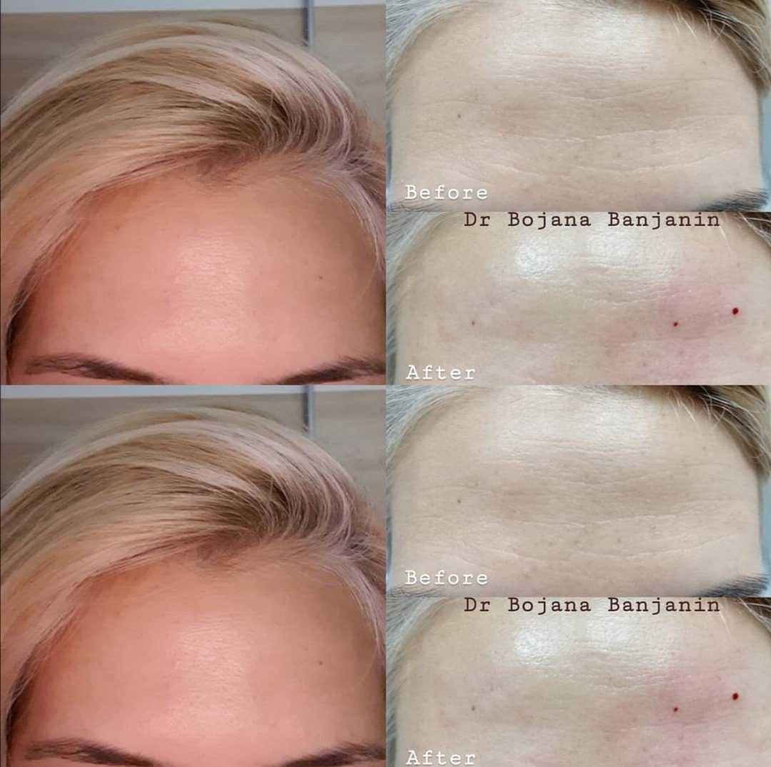 Ordinacija Dr Bojana Banjanin #beograd Botox