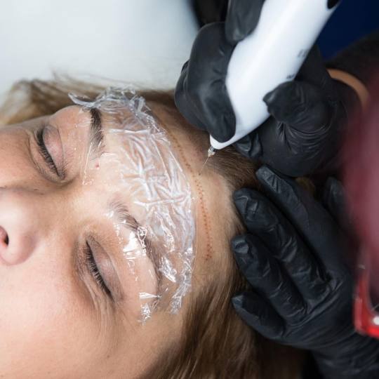 Ashanti Beauty Salon & Academy #beograd Tretman lica Plasma pen - horizontalne bore čela