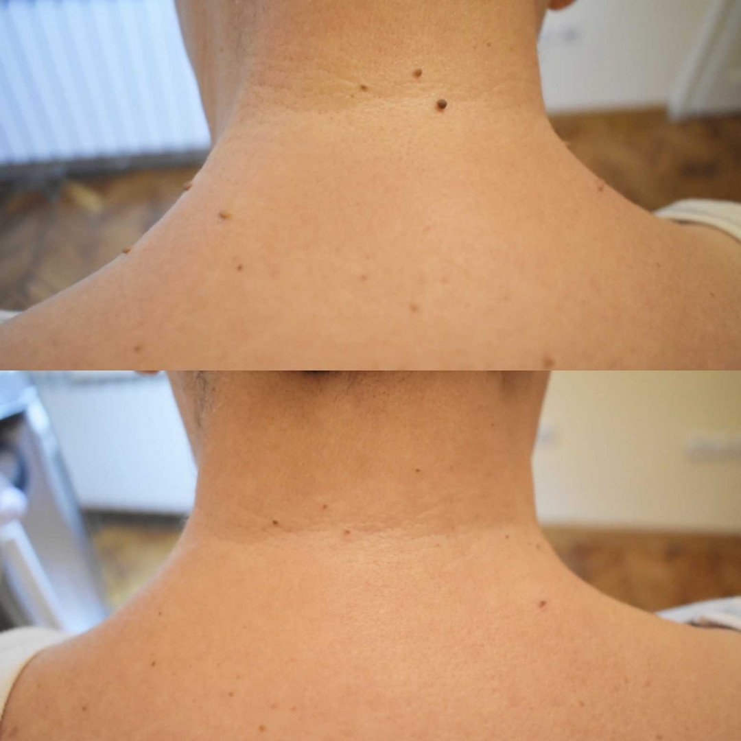 Beauty fit #beograd Tretmani tela Uklanjanje bradavica