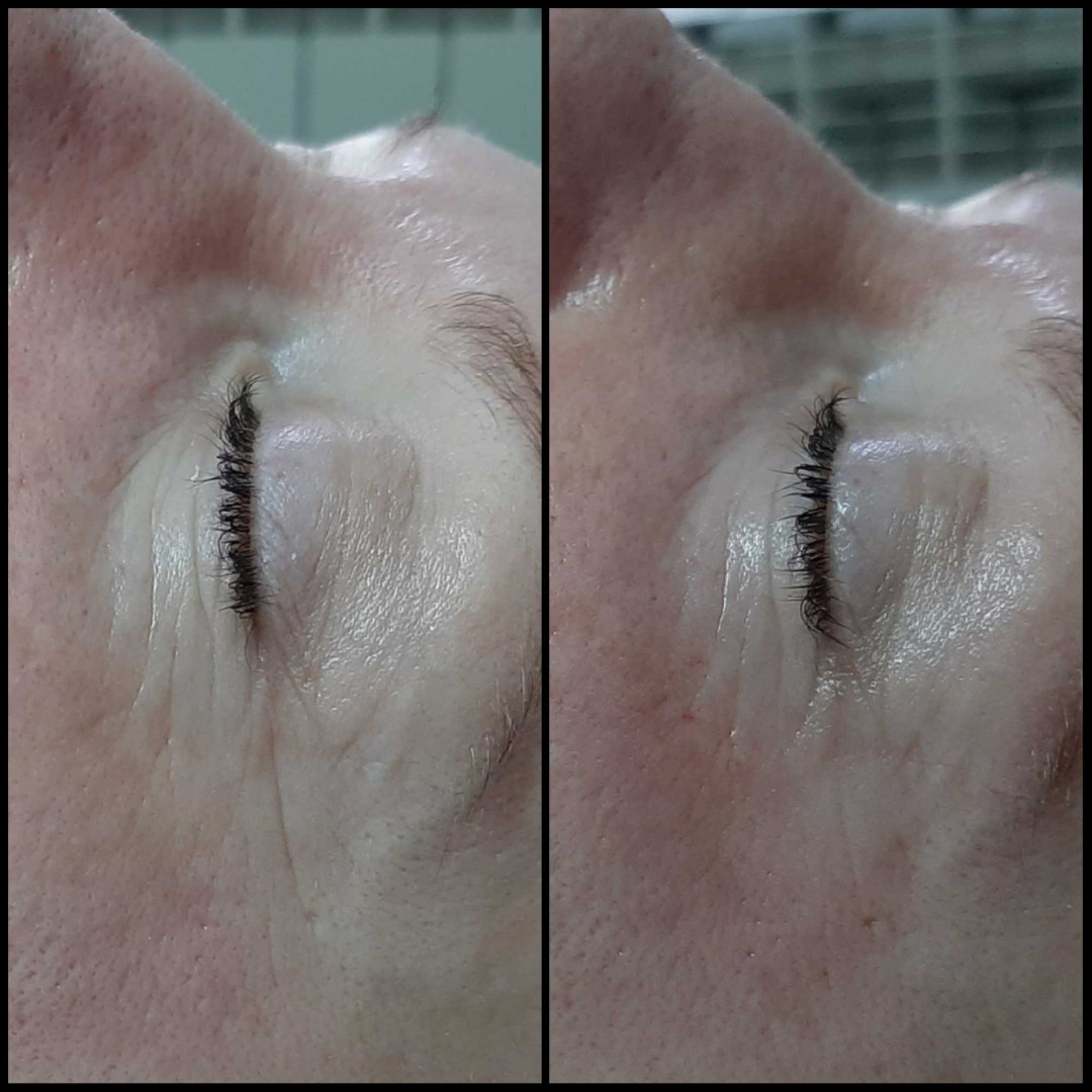 Look at me #beograd Tretmani protiv bora 3D Wrinkle tretman lica