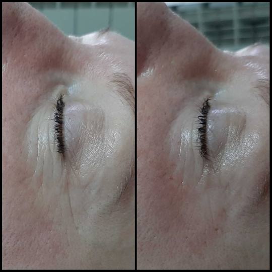 Look at me #beograd Tretmani protiv bora 3D Wrinkle tretman lica rezultati nakon samo jednog tretman