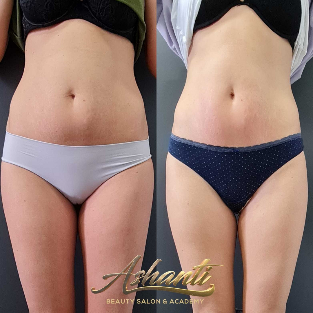 Ashanti Beauty Salon & Academy #beograd Radiotalasni i ultrazvučni tretmani Radiotalasni lifting - po regiji