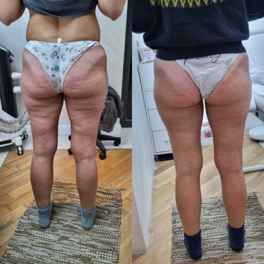 Exclusive Beauty Box #beograd Tretmani tela Body sculpt - paket od 3 tretmana 3 tretmana radio talas