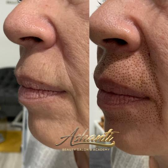 Ashanti Beauty Salon & Academy #beograd Tretman lica Plasma pen - marionetske bore