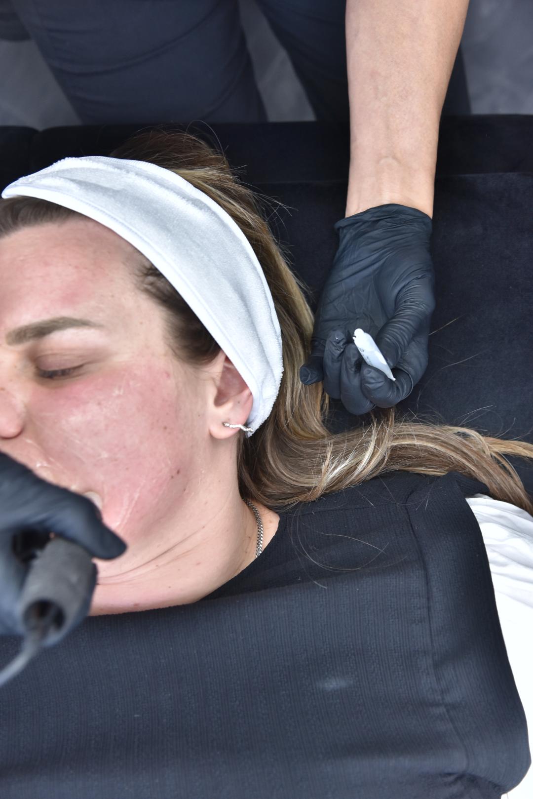 Microneedling tretman - lice - Belle Ana, Beograd Tretman lica Lice Tretman lica, Beograd, Vračar, Čubura, Crveni krst