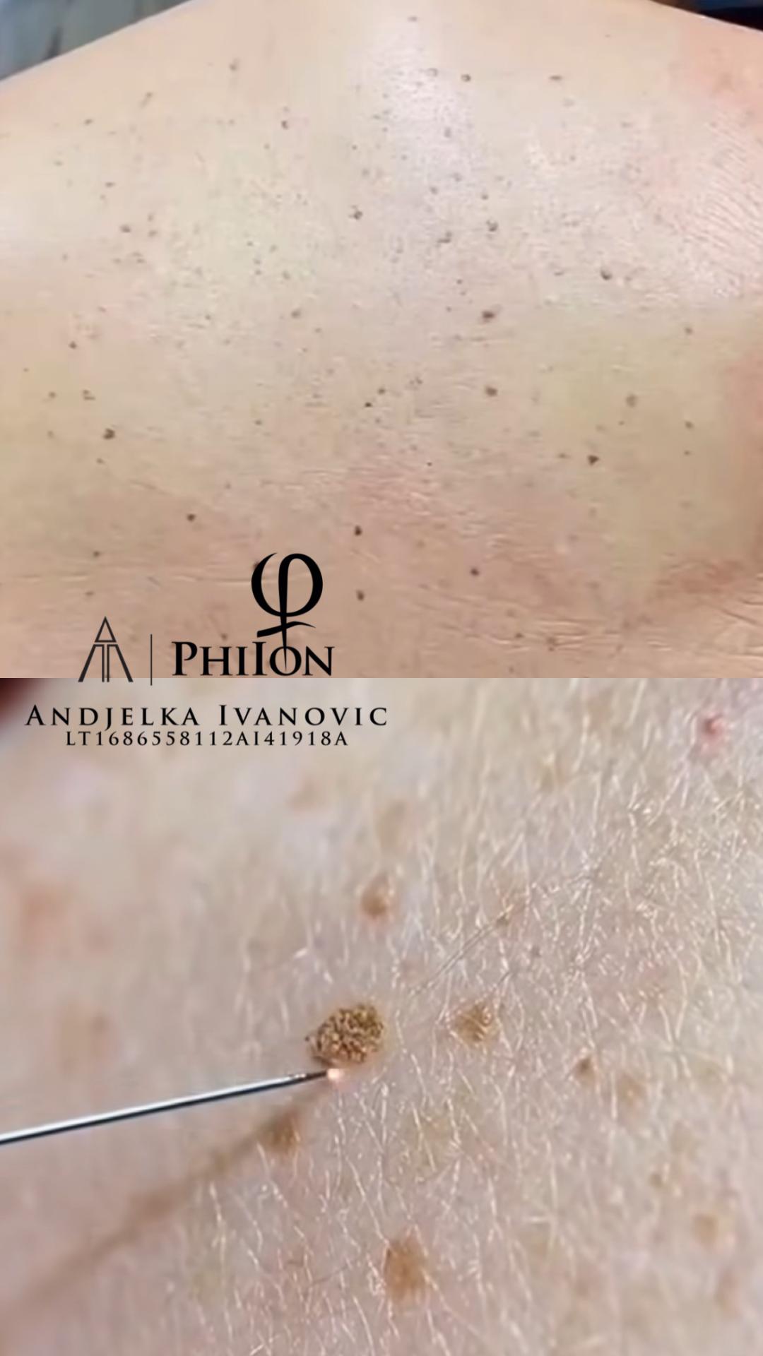 Belle Ana #beograd Tretman lica Phi-Ion tretman - bradavice / papilomi / keratoze / milije / hiperpigmentacija