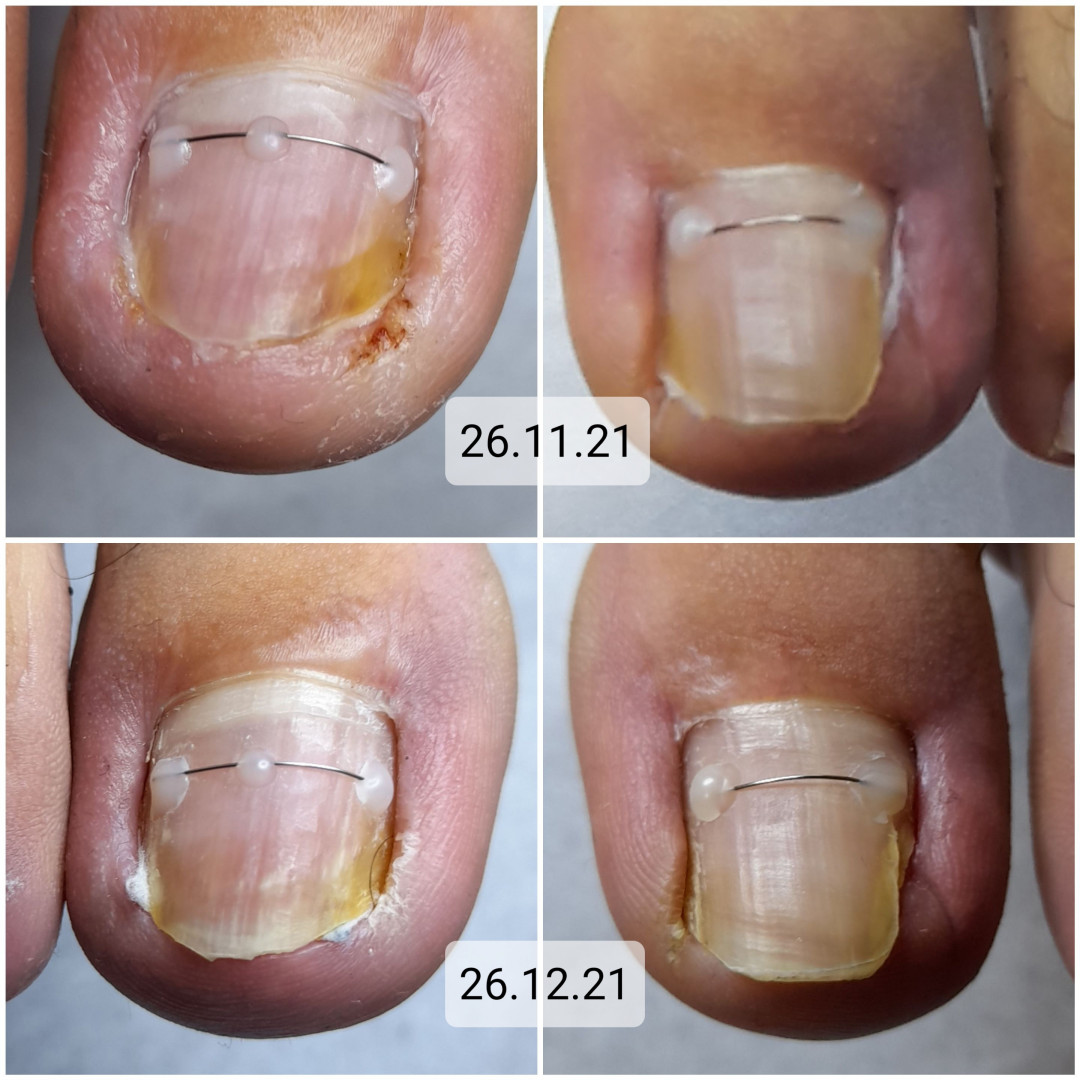 Dr. Prot #beograd Medicinski pedikir Medicinski pedikir - problematičan