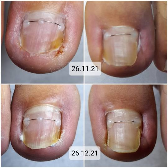 Dr. Prot #beograd Medicinski pedikir Medicinski pedikir - problematičan Urastao nokat
