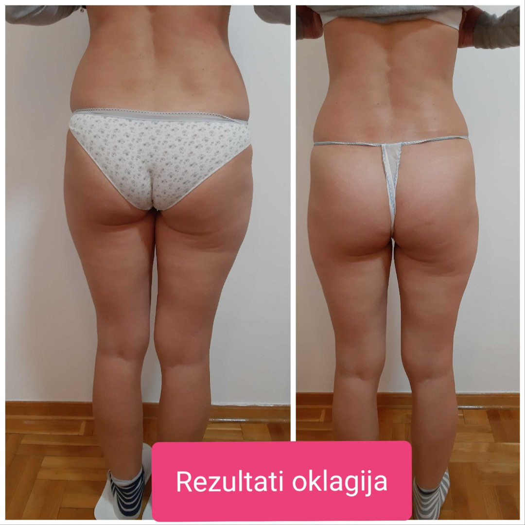 Just You Beauty & Nails #beograd Anticelulit masaža