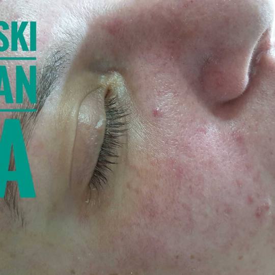 Tina B #beograd Tretman lica
