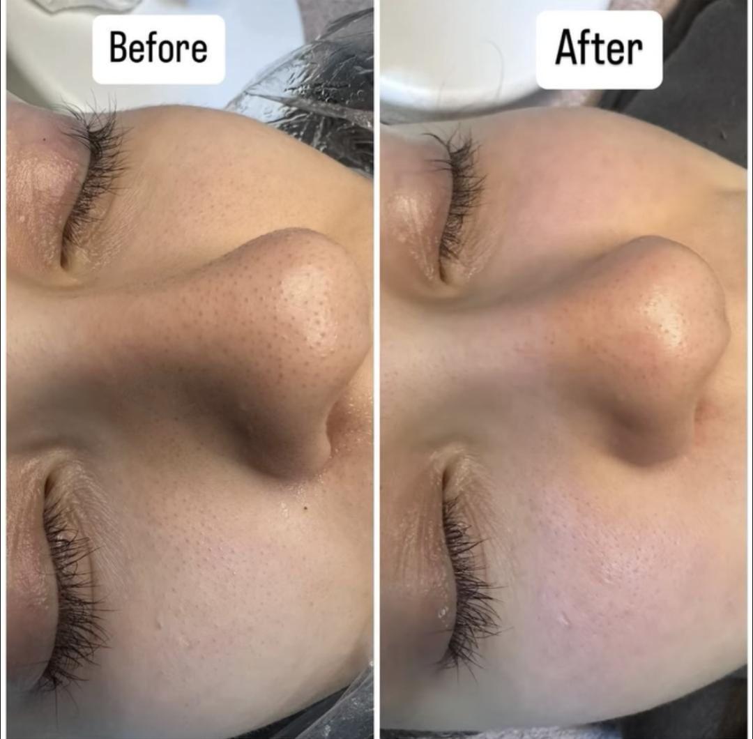 Mladalački tretman čišćenja lica - Petra beauty concept, Beograd Tretman lica Lice Tretman lica, Beograd, Vračar, Čubura, Crveni krst