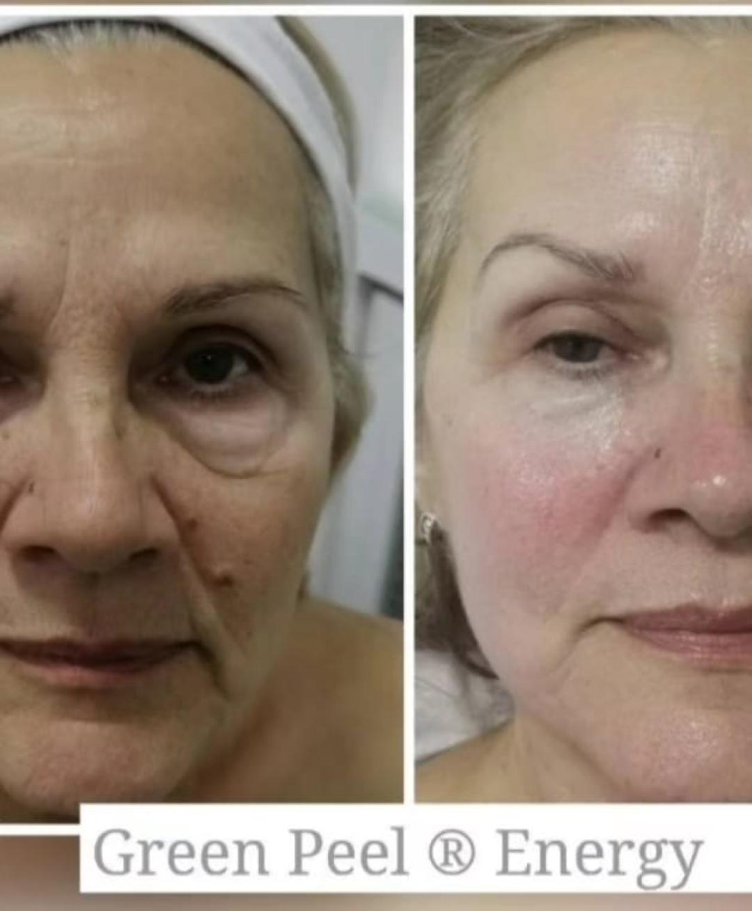 Choco Love #beograd Tretman lica Green peel - Energy