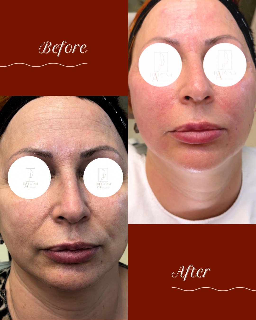 DajanaAesthetics #novisad Dermalni fileri Lola kolagen stimulator