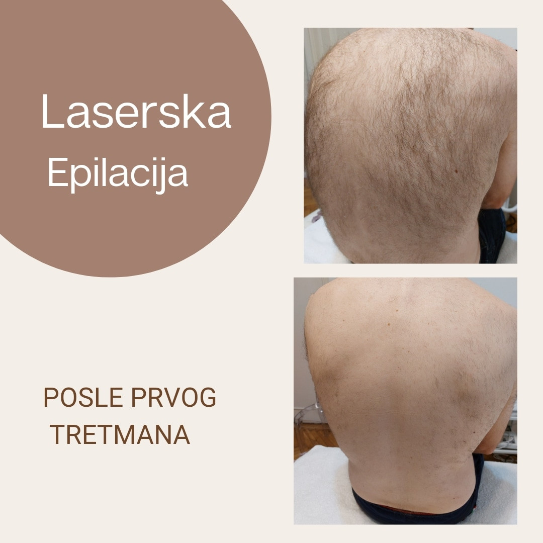 Viva Derm #beograd Laserska epilacija Laserska epilacija leđa + ramena - za muškarce