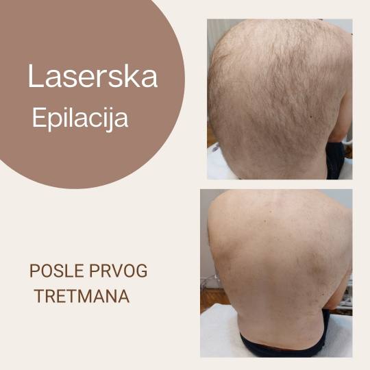 Viva Derm #beograd Laserska epilacija Laserska epilacija leđa + ramena - za muškarce Rešite se ne
