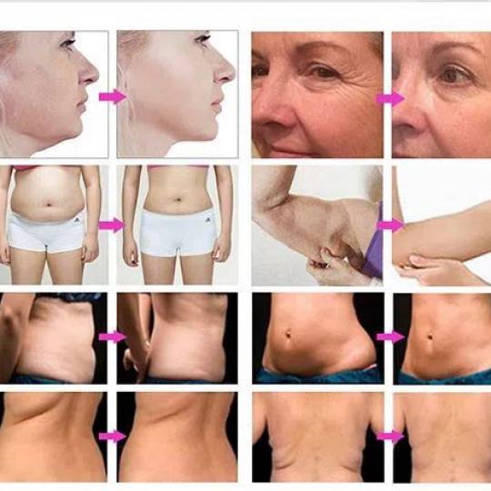 Duluz G&D Beauty #novisad Tretman lica HSR lifting tretman lica 7D HIFU (LASERSKO PODMLAĐIVANJE  LI