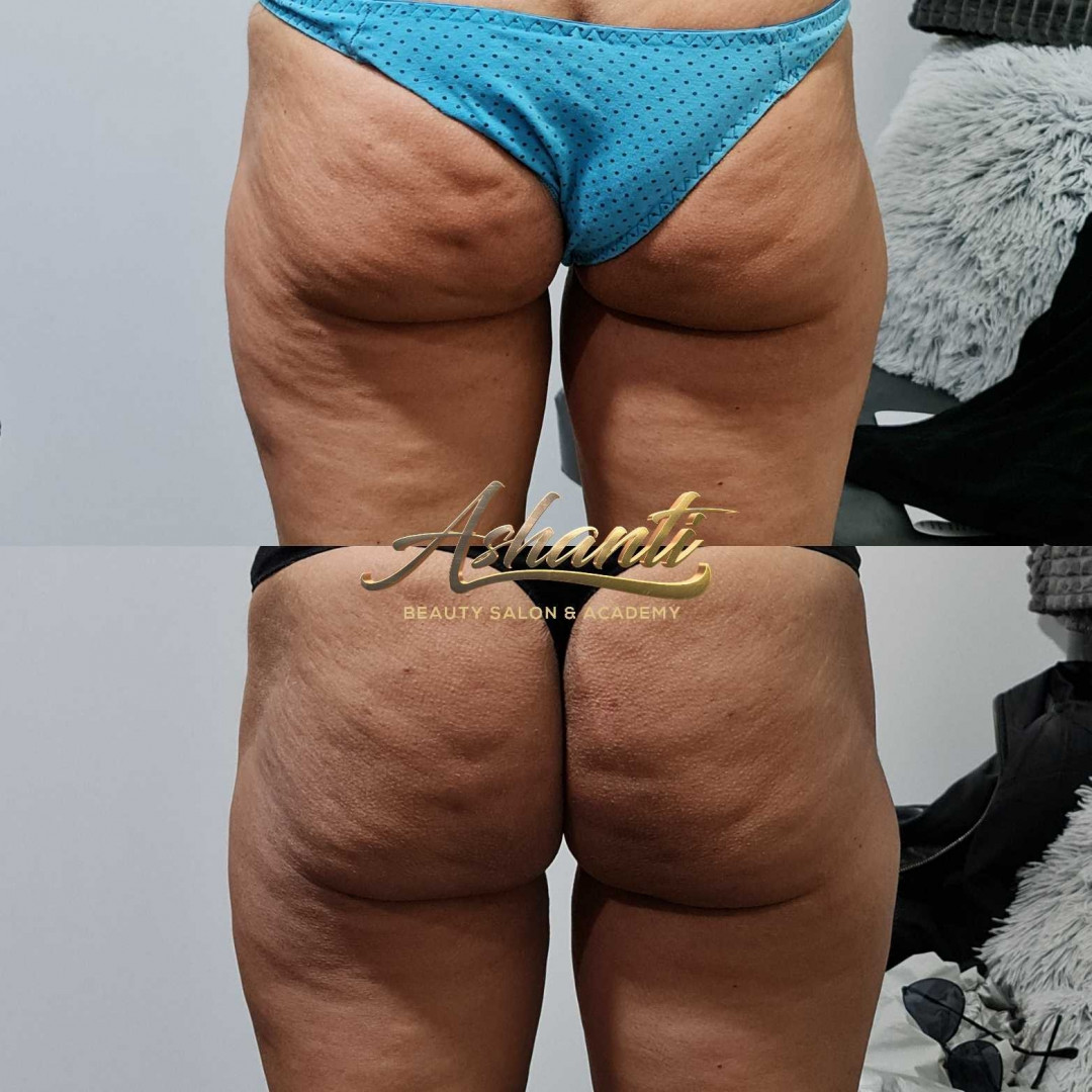 Ashanti Beauty Salon & Academy #beograd Radiotalasni i ultrazvučni tretmani Radiotalasni lifting + vakum sonda - po regiji