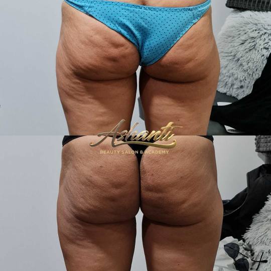 Ashanti Beauty Salon & Academy #beograd Radiotalasni i ultrazvučni tretmani Radiotalasni lifting + 