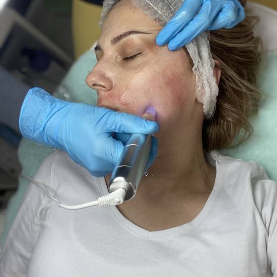 2 Cats 1 #beograd Dermaroler i dermapen Dermapen lice + vrat Poboljšava teksturu kože, povećava p