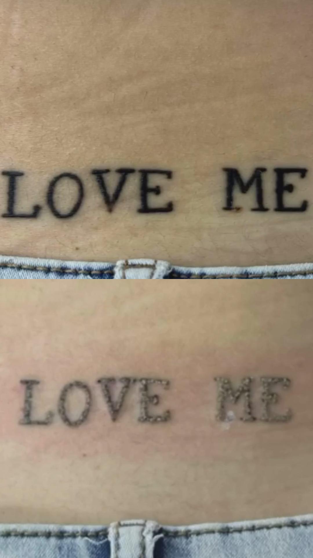 Belle Ana #beograd Uklanjanje tetovaža Lasersko uklanjanje tetovaže