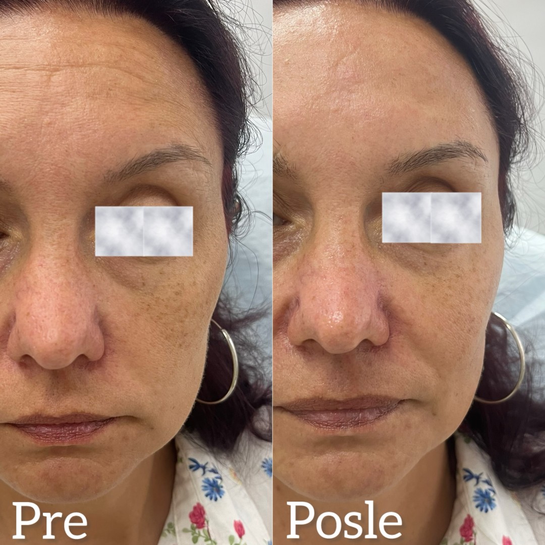 Estetski centar Vlahović #beograd Tretman lica HYDRAFACIAL - regeneracija i rejuvenacija kože