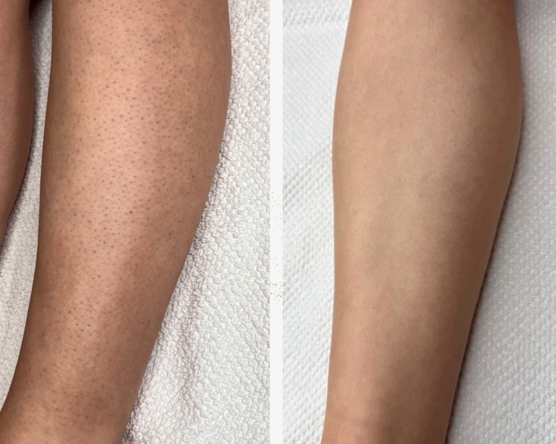 Maison de mi #beograd Laserska epilacija Laserska epilacija celih nogu - za dame