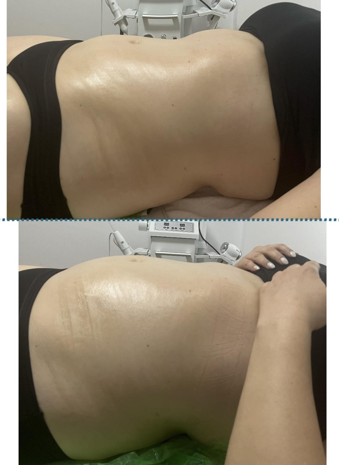 Vacum65body+lipomodelovanje jedne regije - Diamond beauty, Beograd Anticelulit masaža Masaža Anticelulit masaža, Beograd, Zemun Centar