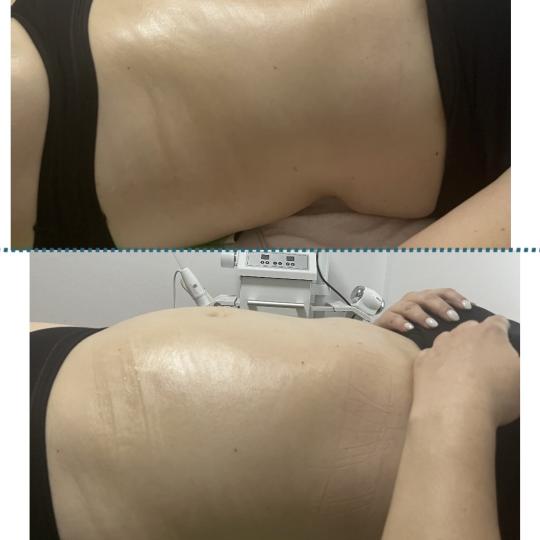 Diamond beauty #beograd Anticelulit masaža Vacum65body+lipomodelovanje jedne regije Osoba se prvo n