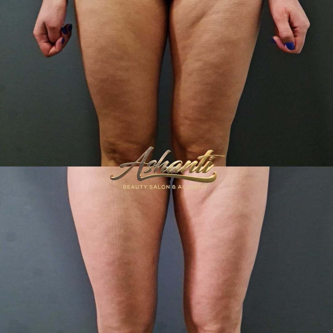 Ashanti Beauty Salon & Academy #beograd Masaža za mršavljenje Premijum maderoterapija