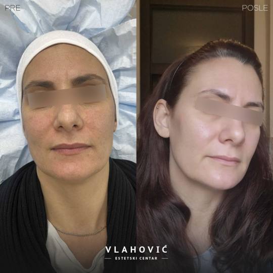 Estetski centar Vlahović #beograd Tretman lica HYDRAFACIAL - regeneracija i rejuvenacija kože Blis