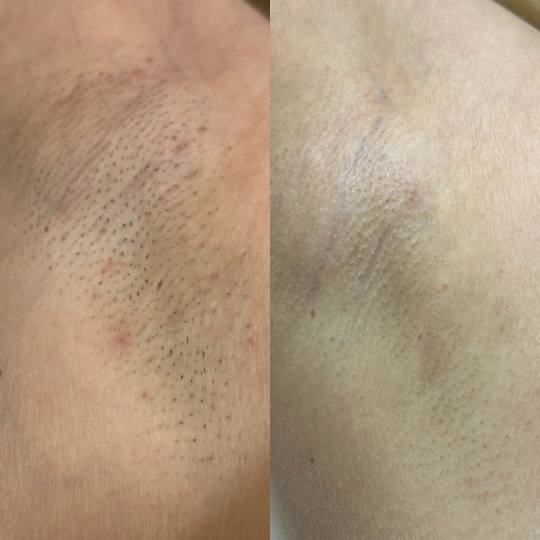 Laser centar Virgo #beograd Laserska epilacija Laserska epilacija pazuha - za dame Depilacija
