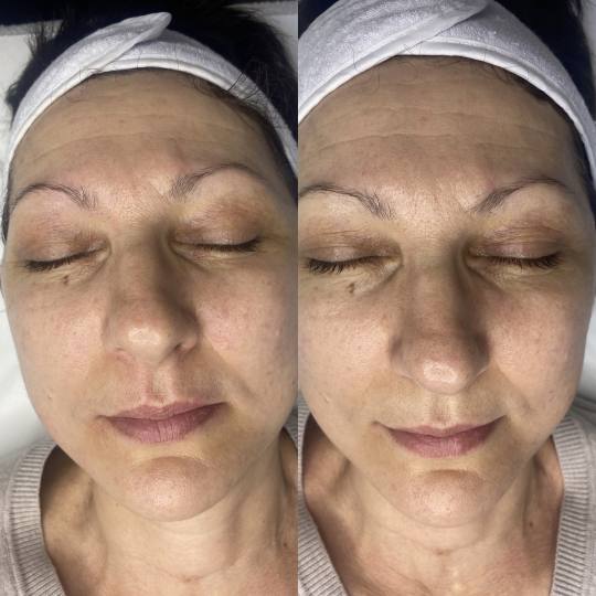 Beauty by Nevena Panić #beograd Tretman lica Winner filer tretman Tretman lica sa prirodnim hijalur