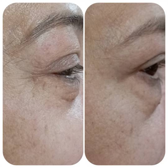 Prestige #beograd Tretman lica Biorevitalizacija lica Letnji tretman idealan za leto, biorevitalizac