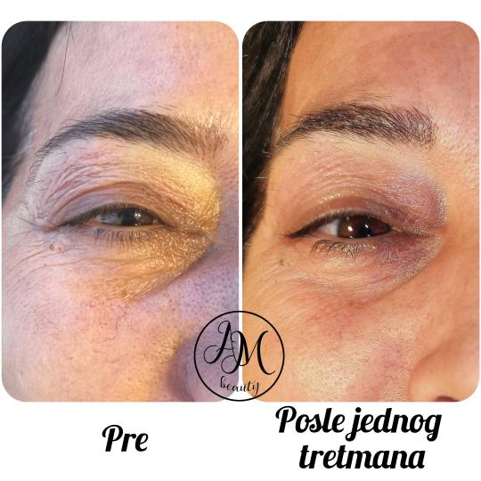 AM BEAUTY STUDIO #odzaci Radiotalasni i ultrazvučni tretmani Plasma pen - gornji kapci