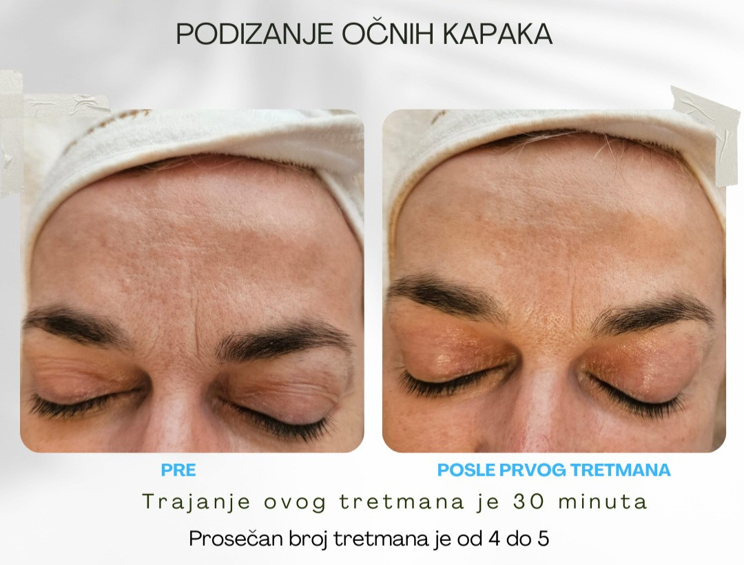 Viva Derm #beograd Tretman lica Tesla MED - Blefarokil (podizanje kapaka)
