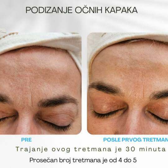 Viva Derm #beograd Tretman lica Tesla MED - Blefarokil (podizanje kapaka)