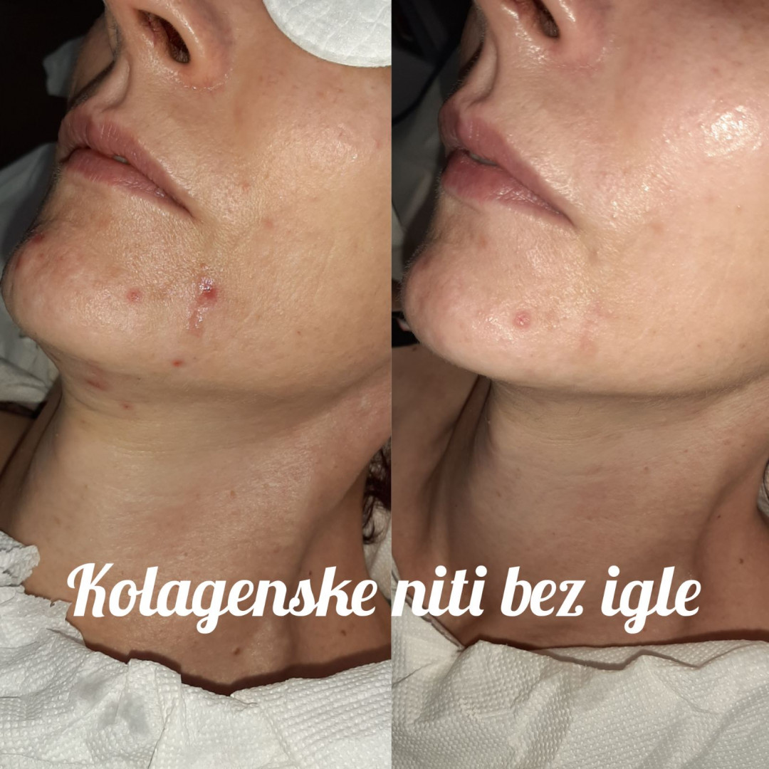 Elin Sary Mary Kutak #beograd Medicinski pedikir Derma Fix tretman lica sa kolagenskim nitima