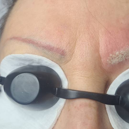 Laser centar Delight #beograd Trajna šminka Uklanjanje trajne šminke laserom obrva ili usana Razlo