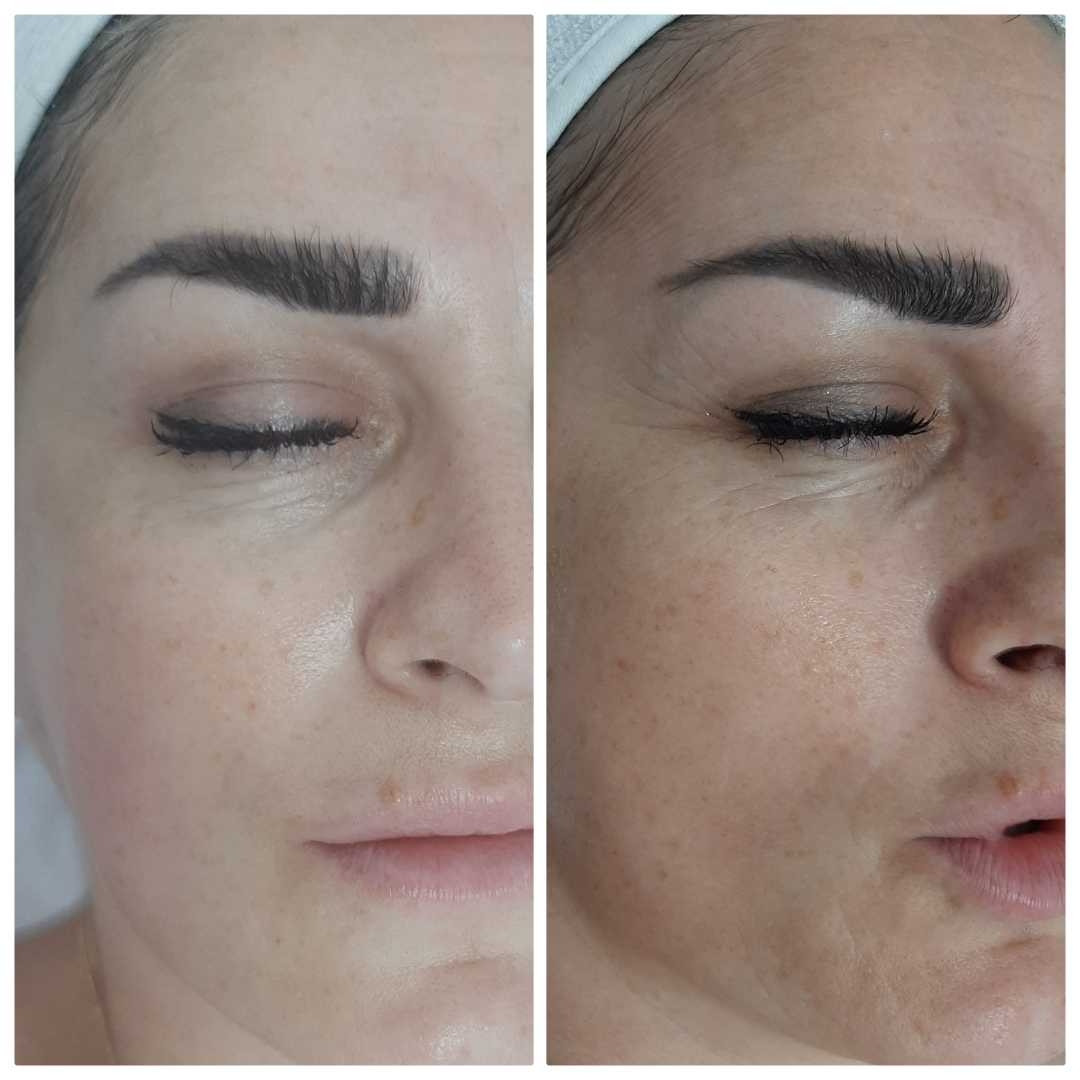 Felicita #beograd Tretman lica Hydro Pro Facial 7in1