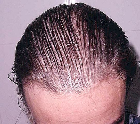 Vila Beauty Studio #beograd Tretman rasta kose Stimulacija rasta kose dermapenom