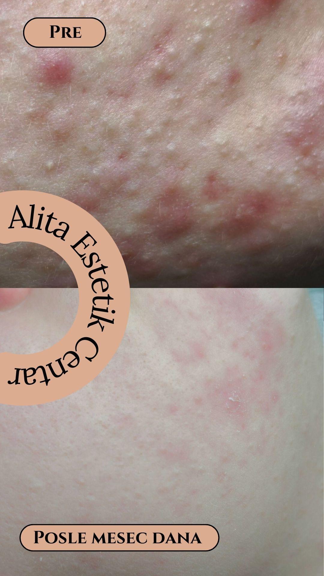 Alita Estetik Centar #novisad Tretman lica Tretman lica za aknoznu kožu