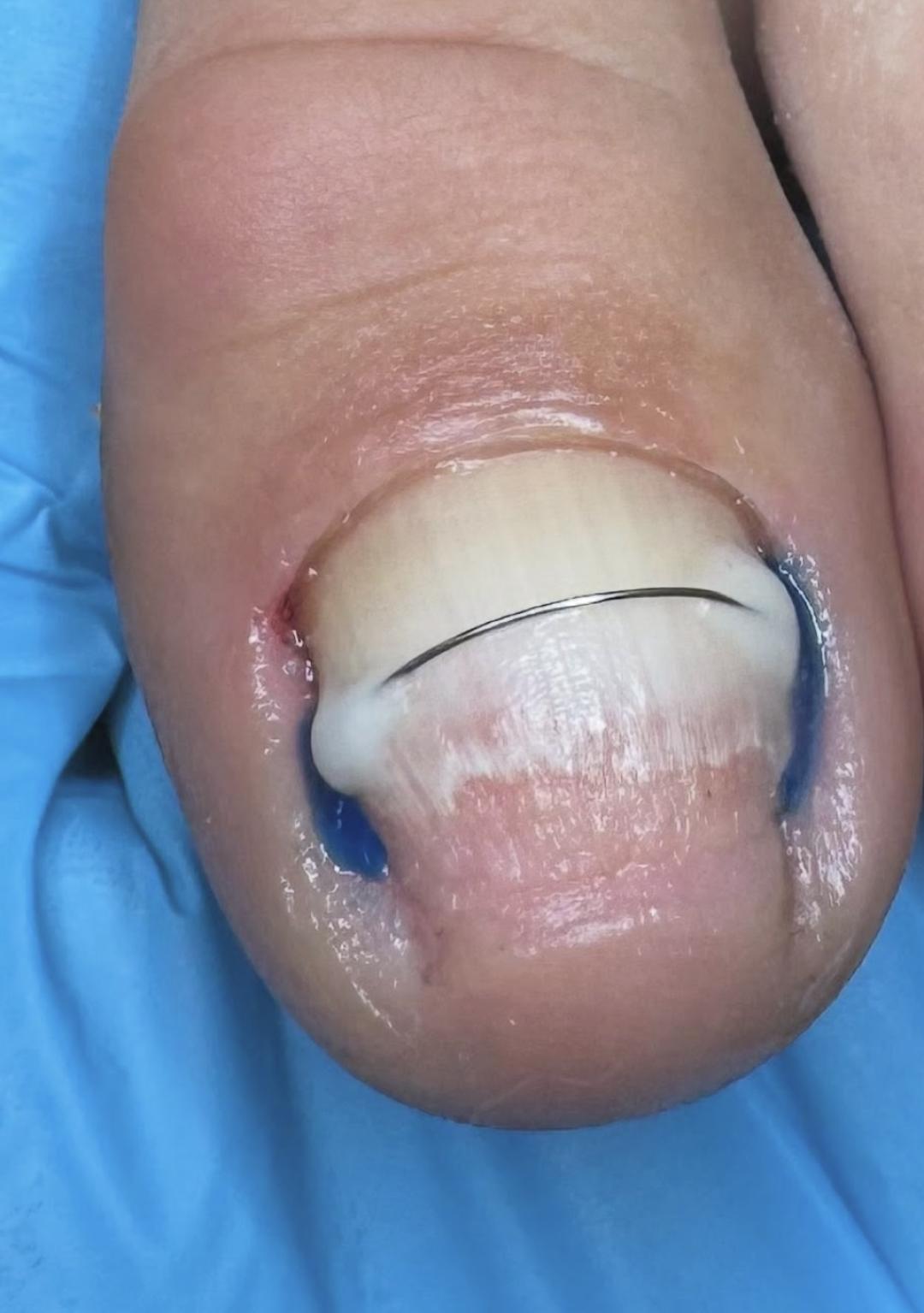 Protetika nokta - 1 nokat - Esthetics Milica, Mionica Medicinski pedikir Nokti Medicinski pedikir, Mionica, Centar