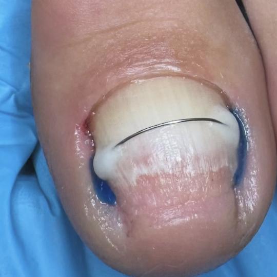 Esthetics Milica #mionica Medicinski pedikir Protetika nokta - 1 nokat ✔ Bol smanjen na minimum od