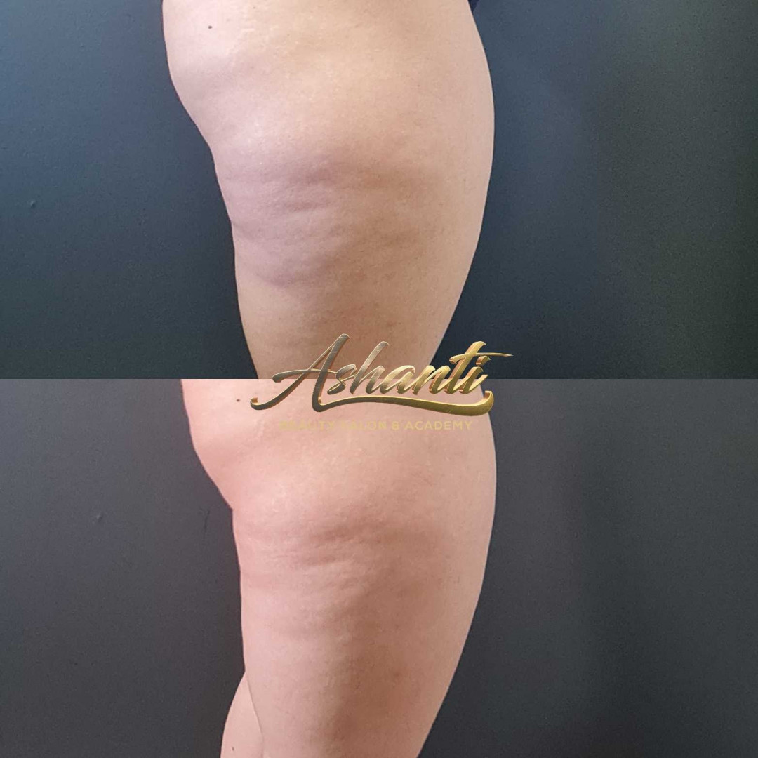 Ashanti Beauty Salon & Academy #beograd Masaža za mršavljenje Dermapen - regija lica