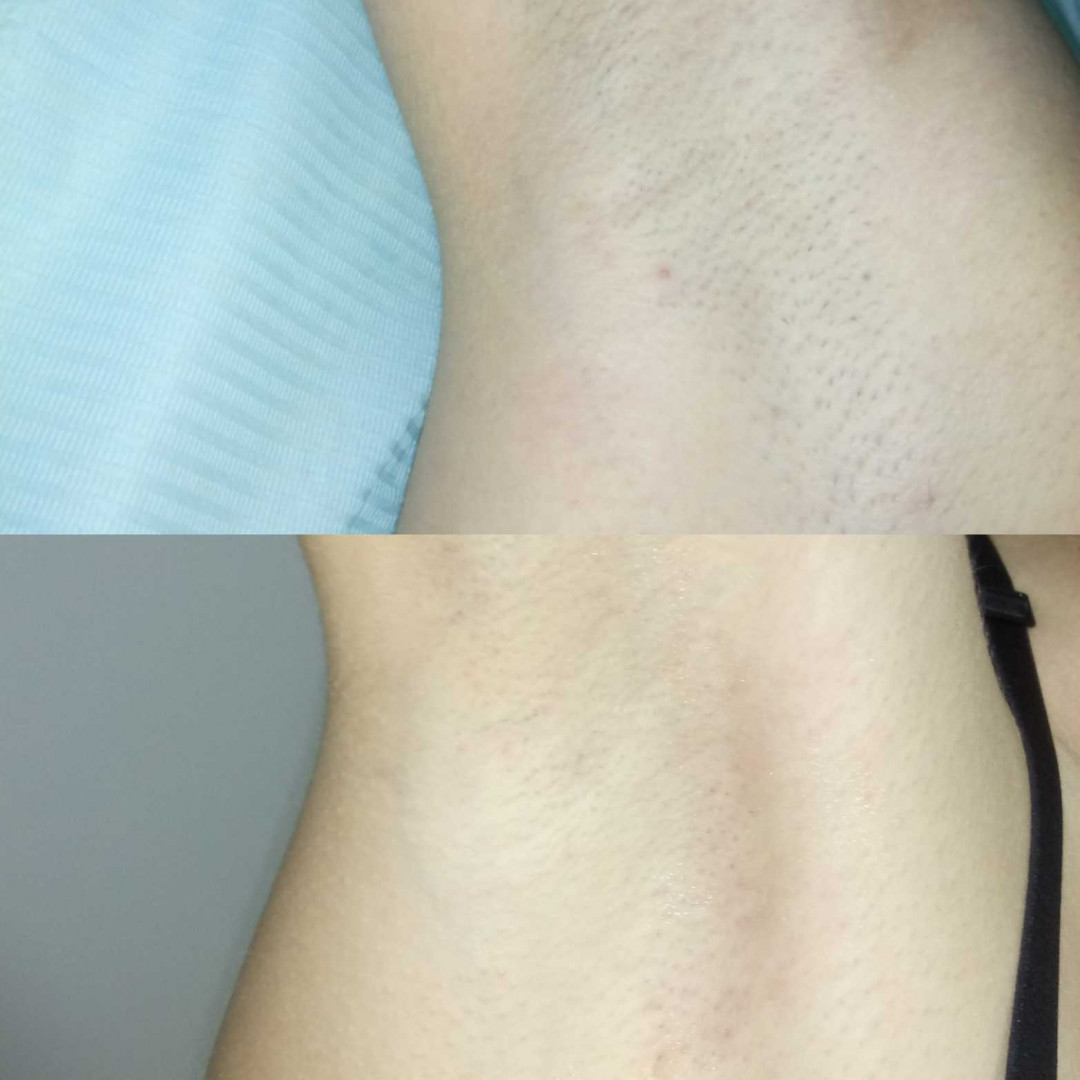 Krasiva #beograd Laserska epilacija Laserska epilacija pazuha - za dame