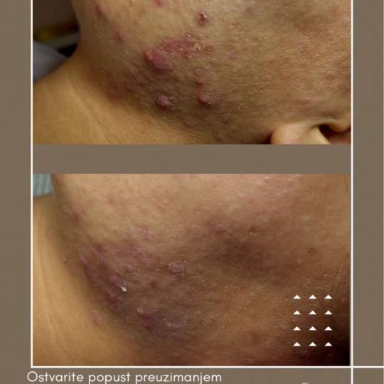 Lancier Beauty Expert #beograd Tretman lica Higijenski tretman lica